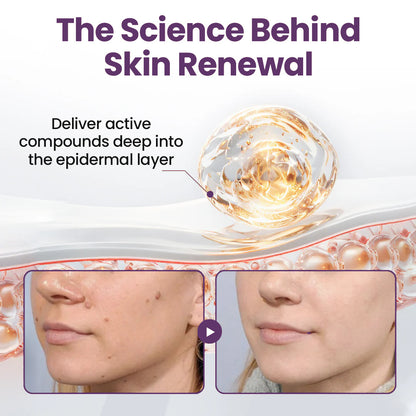 💜✅Pheromex®Dual-Action Plant Wart Removal Cream（👨‍⚕️Skin Tags,Acne,Hyperpigmentation,Eczema,Psoriasis,Rosacea,Warts)