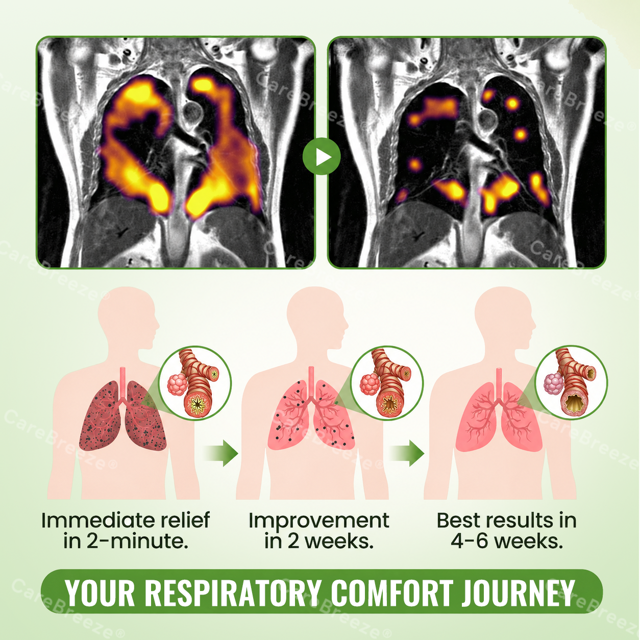 🇬🇧 ✅CareBreeze® Advanced Botanical Mullein Lung Cleanse Melt Strips（👨‍⚕️Directly acts on COPD, asthma, chronic bronchitis (CB), respiratory infections, lung cancer, sinusitis, and other conditions）