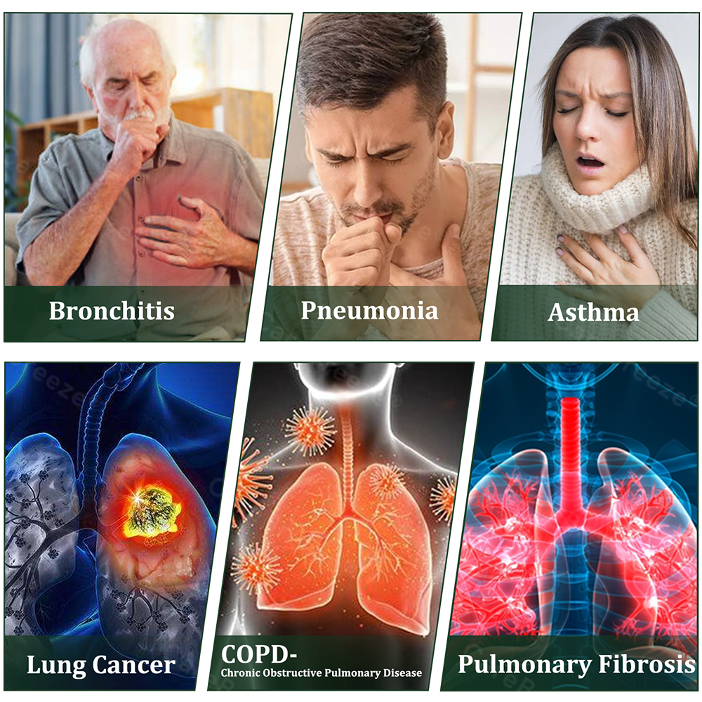 💚🇬🇧 Official Store:CareBreeze® 6-in-1 Herbal BeePropolis Lung Cleanse Spray🐝（👨‍⚕️Directly acts on COPD, asthma, chronic bronchitis (CB), respiratory infections, lung cancer, sinusitis, and other conditions）