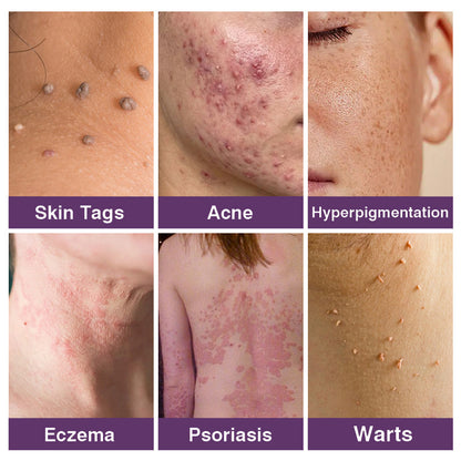 💜✅Pheromex®Dual-Action Plant Wart Removal Cream（👨‍⚕️Skin Tags,Acne,Hyperpigmentation,Eczema,Psoriasis,Rosacea,Warts)